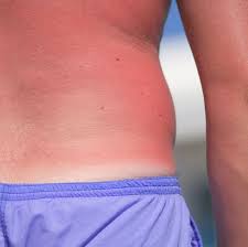 Your scalp is one of your body parts exposed most to the sun, especially if you are bald or have thin hair. How To Soothe Your Sunburn In 6 Easy Steps Sunburn Relief Tips