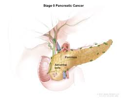 Your pancreas releases enzymes that aid digestion and produces hormones that help. Pancreatic Cancer Treatment Adult Pdq Patient Version National Cancer Institute