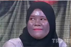 Begini kondisi terbaru Lenny yang wajahnya gosong karena pakai krim  bermerkuri dari skincare abal-abal