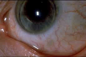 Colirios Para Los Ojos Rojos Ocularis