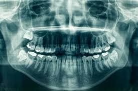 Impression technology currently available for dentists to use. Dental X Rays Panoramic Vs Traditional J D Bo Westmoreland D D S