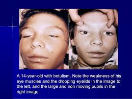This is called latrogenic botulism. Botulism
