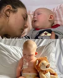 Estella Patrick was born with Spina Bifida. Fortunately she was able to  have corrective surgery when she was 3 months old