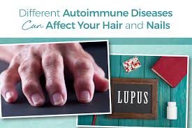 Lastly, my second choice for medication was copaxone, which also does not list hair loss as a side effect however i saw ms connection comments regarding hair loss with this drug as well. Autoimmune Disease Can Damage Skin Hair Nails