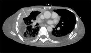 Brain metastases may cause various signs and symptoms. Imaging Biomarkers For Evaluating Tumor Response Recist And Beyond Springerlink