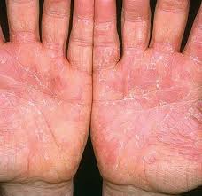 Health What Is Exfoliative Keratolysis Skin Peeling Treatment Foot Remedies Peeling Skin