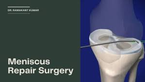 We did not find results for: How To Sleep After Meniscus Surgery Archives Dr Ramakant Kumar