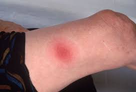 Bug Bites That Look Like Mosquito Bites But Hurt Slideshow What You Need To Know About Fleas And Ticks Tick Bites Pictures Tick Symptoms Bed Bug Bites Pictures