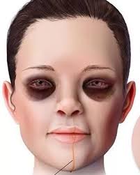 Paciente presentada después de una pelea con su marido con esta apariencia.  ¿Cuál es tu diagnóstico?