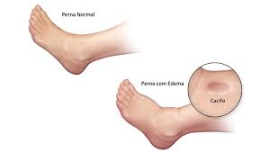 (archaic) a clutter in liquid, notably: Trombose Venosa Profunda Tvp Barao Vascular Medico Vascular Sp