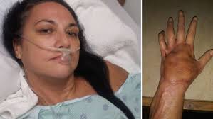 There are two types of paronychia: Papercut On Us Woman S Pinky Finger Leads To Sepsis Necrotising Fasciitis 7news Com Au
