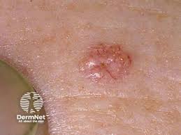 Image result for Sebaceous Hyperplasia