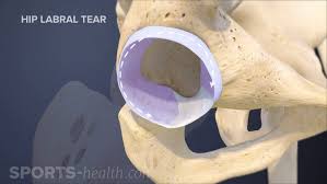 Image result for Hip Labral Tear