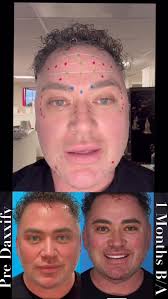 💉FULL DOSE AND PLACEMENT VIDEO💉 , ⚠️ Disclaimer: Advanced injection  techniques below the line of convergence should only be performed by  properly trained injectors., 📩 If you’re a provider, reach out ...