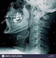 They show pictures of your internal tissues, bones, and organs. X Ray Normal Cervical Spine Stock Photo Alamy