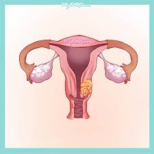 Apakah risiko ujian pap smear? 4 Klinik Rawatan Pap Smear Tidak Normal Terbaik Johor Bahru Harga Ulasan