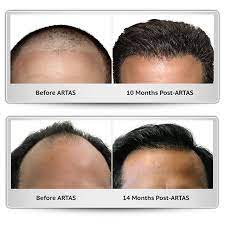 Aesthetic Scalp Strives To Help Patients Both Men And Women With Noticeable Hair Loss We Apply The Latest In Science An Lost Hair Hair Loss Hair Restoration
