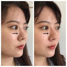 Building Bridge On Nose Nsnj Nose Fillers Nonsurgical Nose Job Nose Job