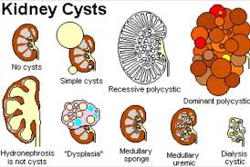 Renal Cysts Kidney Cyst Vascular Ultrasound Ultrasound
