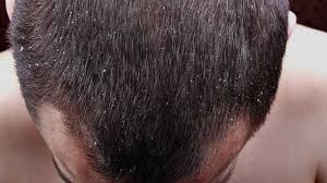 Maybe you would like to learn more about one of these? Christmas Hair And Scalp Psoriasis Irish Skin Foundation