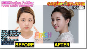 Korean Plastic Surgery Engfreshps Com Korean Plastic Surgery Wonderful V Korean Plastic Korean Plastic Surgery South Korean Plastic Surgery Plastic Surgery