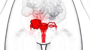 Ovarian cancer can attach to the intestinal tract, causing symptoms that mimic irritable bowel syndrome (ibs). Irregular Periods Could Boost Ovarian Cancer Risk Science Aaas