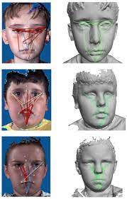 Recognizing autism in girls can be a real struggle since the spectrum was practically made for boys! Facial Measurements Resurface In Search For Autism Clues Spectrum Autism Research News