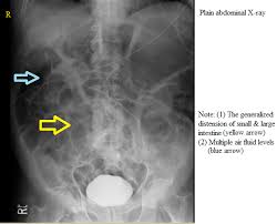 Image result for Adynamic Ileus