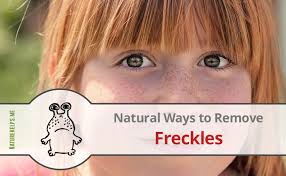 The color of the freckles may be darker or lighter depending on your skin color. Easy Natural Ways To Remove Freckles
