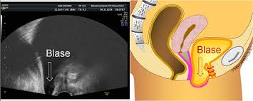 Dauer der krankschreibung nach bauchschnitt. Lowsfullisan Heben Nach Gebarmutterentfernung