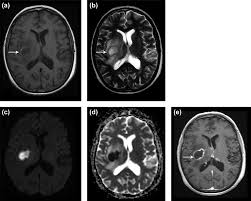Image result for Brain Abscess