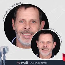 🇫🇷 Un sourire restauré — sans greffe, sans attente. 🦷 Grâce à la  technologie BAx et aux implants basaux, nos patients retrouvent rapidement  fonction et esthétique. Pourquoi choisir cette méthode : ✓