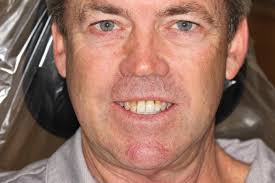 Check out these amazing before/after photos for our awesome patient! 🤩  Shawn incurred significant dental trauma from a softball accident in the  past. The accident caused tooth loss as well as gradual