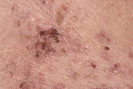 Image result for zoster under breasts