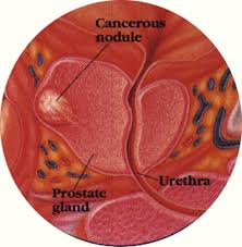 It may grow slowly and it's typically treatable. Enlarged Prostate Prostate Cancer Treatment Hospital India