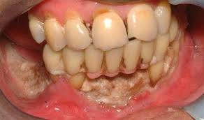 Image result for Bisphosphonates