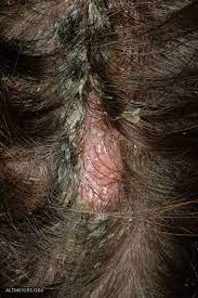Pityriasis amiantacea is an eczematous condition of the scalp in which thick tenaciously adherent scale infiltrates and surrounds the base of a group of scalp hairs. Pityriasis Amiantacea Altmeyers Encyclopedia Department Dermatology