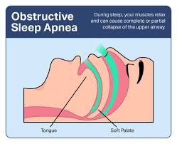 Image result for Sleep Apnea