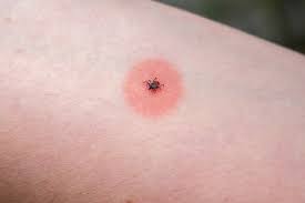 Image result for infected tick bite