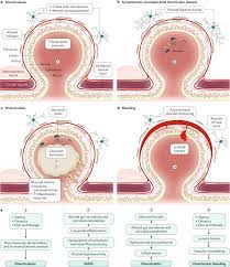 Colonic Diverticular Disease Nature Reviews Disease Primers