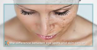 If you aren't sure which type of skin cancer. Skin Cancer Or Age Spots Learn The Difference From Our Boulder Dermatologists Kallgren Dermatology Clinic