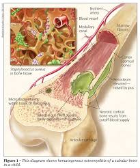 Image result for Osteomyelitis