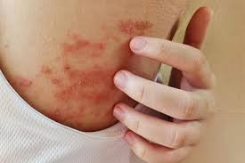 Image result for Atopic Dermatitis