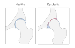 Image result for what hip dysplasia causes symptoms and treatment