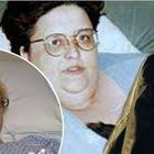 Perde 170 chili con bendaggio gastrico: muore per le complicazioni 16 anni  dopo