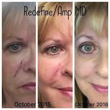 After revealing her breast implant order, Kylie Jenner accidentally exposes  "huge" scar in photo (link in the comments)