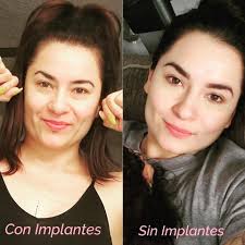 A month ago I explained and I feel Happy my face no more inflamed and Super  lighter the best decision of my life❤💫❤