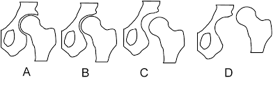 Hip Dysplasia Human Wikidoc