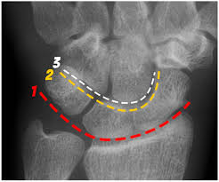 Image result for Scapholunate Dislocation