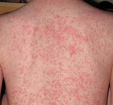 Image result for sweat rash on back